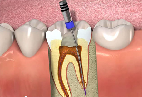 canal-dentista-copacabana