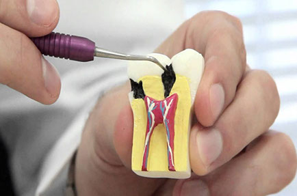 tratamento-canal-dentista-copacabana